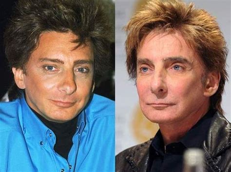 Barry Manilow before and after plastic surgery (5) – Celebrity plastic ...