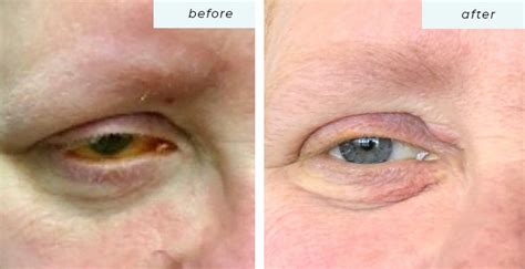 IPL Treatments for Dry Eye & Skin Evening | Greater Boston Optometry ...