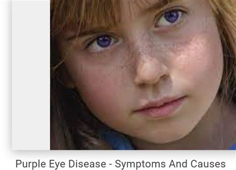 Violet Eyes Disease