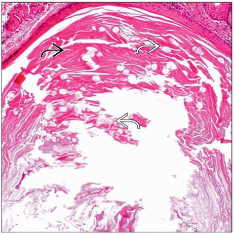 Vellus Hair Cyst | Basicmedical Key