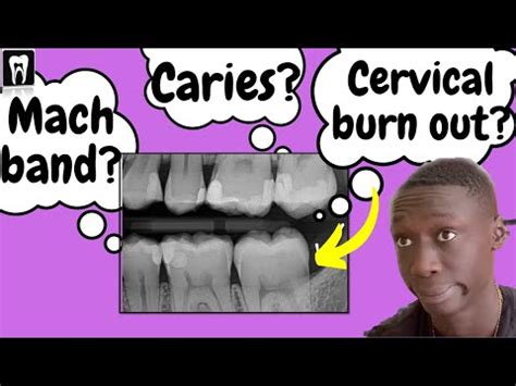 Caries Vs Cervical Burnout Vs Mach Band Effect | Interpretation of ...