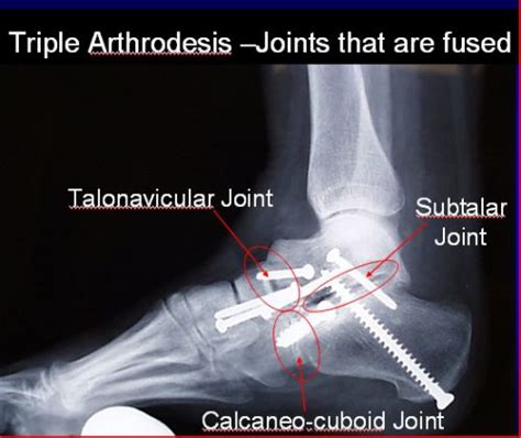 Arthrodèse Triple - FootEducation