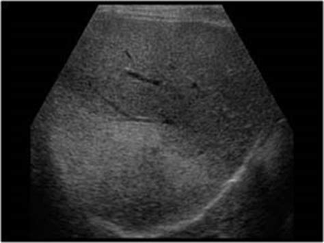 Abdomen and retroperitoneum | 1.1 Liver : Case 1.1.11 Fatty liver and focal sparing | Ultrasound ...