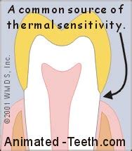 Problems with permanent and temporary crowns- Pain/Sensitivity/Toothache