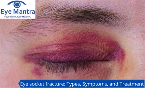 Eye Socket Fracture: Types, Symptoms, Treatment