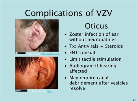 GEMC: Herpes Zoster: Resident Training