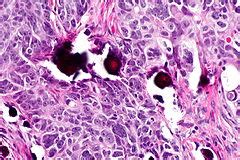 Serous carcinoma of the ovary - Libre Pathology