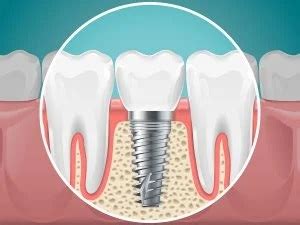 What is osseointegration? | Charlottesville Oral Surgery