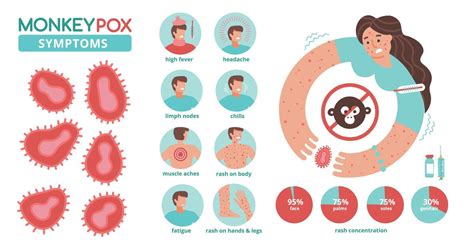 Monkeypox virus symptoms infographics. New orthopox virus outbreak worldwide spreading. Detailed ...