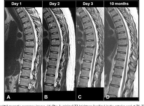 Thoracic disc herniation leads to anterior spinal artery syndrome demonstrated by diffusion ...