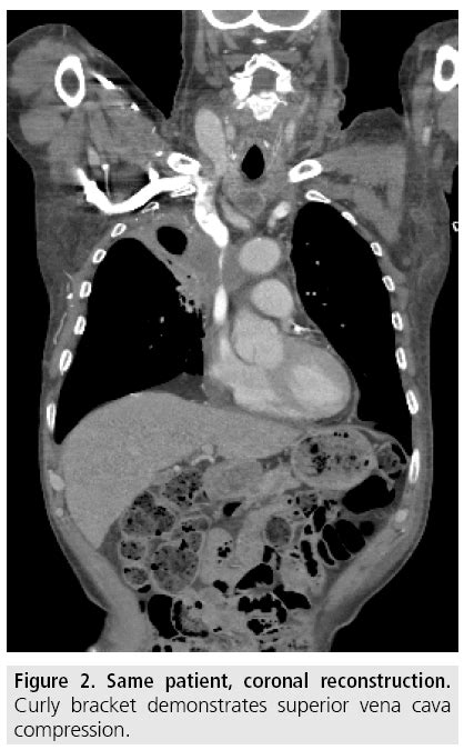 Stenting in malignant superior vena cava syndrome review advances