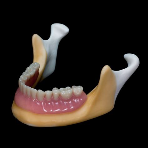 DS-07 Fully Edentulous Mandible with Overdenture | Paradigm Dental Models