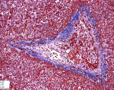 hepatic veno-occlusive disease - Humpath.com - Human pathology