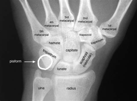 Radiographic Anatomy of the Skeleton: Wrist -- Posteroterior (PA) View ...