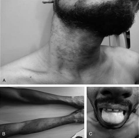 Ammonia Exposure: A Review of Six Cases : The American Journal of ...