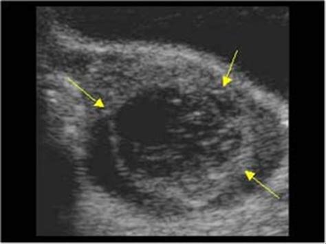 Ruptured Ovarian Cyst