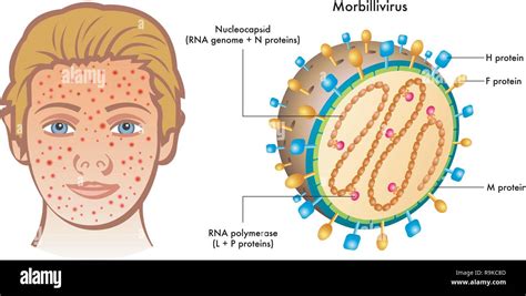 Cutaway labelled diagram of Morbillivirus with illustration of boy ...