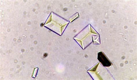 Types of Crystals Found In Human Urine and Their Clinical Significance | Faculty of Medicine