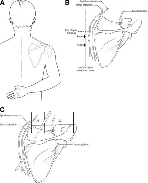 Spinal Accessory Nerve Damage Treatment