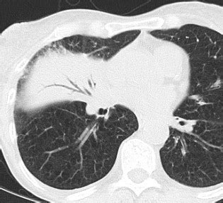 Air bronchograms – CT - Radiology at St. Vincent's University Hospital