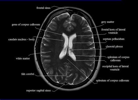 MRI anatomy brain axial image 18 | Brain anatomy, Mri brain, Brain scan