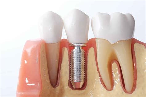 What Are Mini Dental Implants? A Quick Guide | Parul Mehta DDS