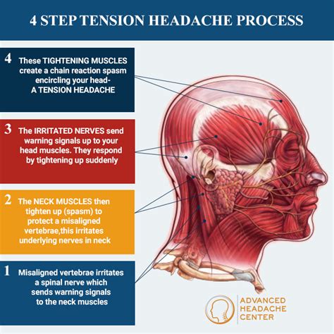 Understanding and Managing Your Tension Headache | Advanced Headache Center