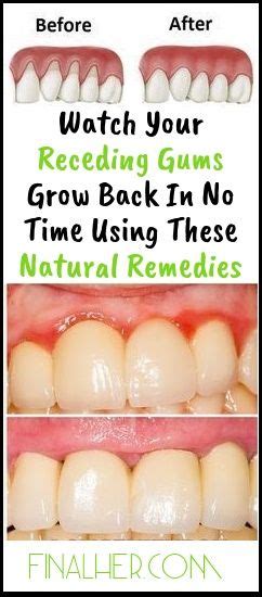 Grow Back Your Receding Gums With These Natural Remedies ! - BEAUTIFUL DIY AND HEALTH