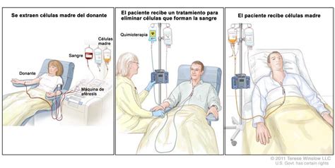 Trasplante de células madre. (Panel 1): ilustración de la extracción de células madre de un ...