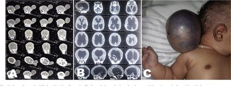 Figure 2 from Shunt exposure as a ventriculoperitoneal shunt ...