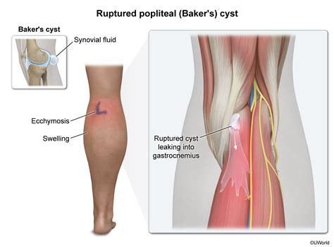 Ruptured Popliteal (Baker's) Cyst — Cote Illustration