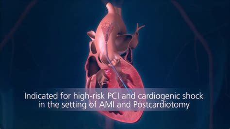 Impella® Heart Pump Animation: For Physicians | Heart pump, Cardiogenic ...