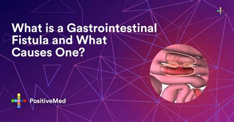 What is a Gastrointestinal Fistula and What Causes One? - PositiveMed