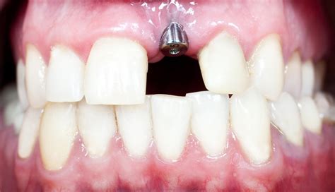 Dental Implants Side Effects and Risks Explained - Dezy