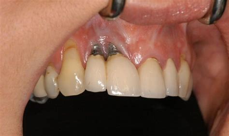 Signs Bone Failure Dental Of Graft