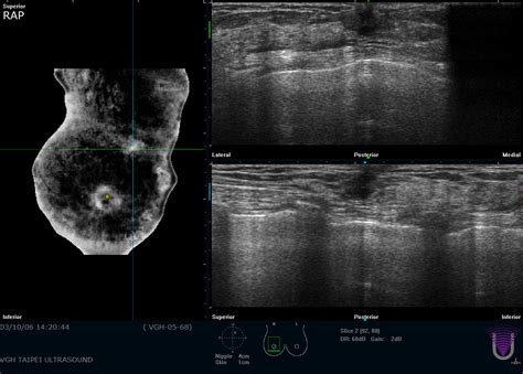 Improving diagnosis time in whole breast ultrasound | SPIE Homepage: SPIE