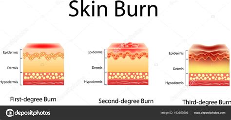 1St Degree Burn Pictures, First Degree Burns Image & Photo (Free Trial) | Bigstock, Download ...