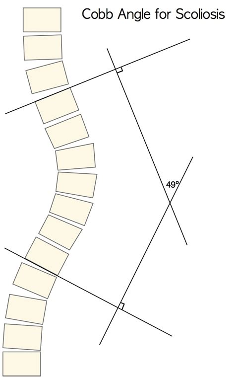 Cobb Angle Measurement - Scoliosis 3DC®