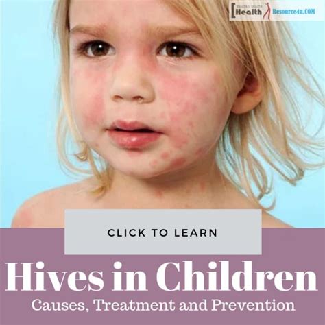 Hives In Children: Causes, Picture, Symptoms And Treatment