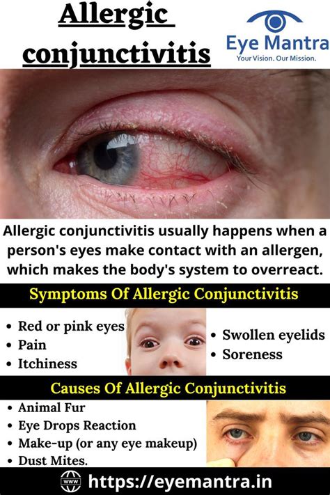 Allergic conjunctivitis symptoms types causes and treatment – Artofit