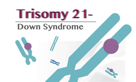 Trisomy 21 (Down Syndrome): Definition, Causes, Symptoms, Pictures and ...