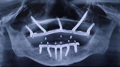 Treatment of the Severely Atrophic Arch with Zygomatic, Pterygoid, and ...