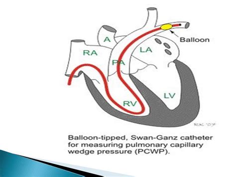 Pulmonary wedge pressure; Pulmonary Artery Wedge Pressure; Pulmonary ...