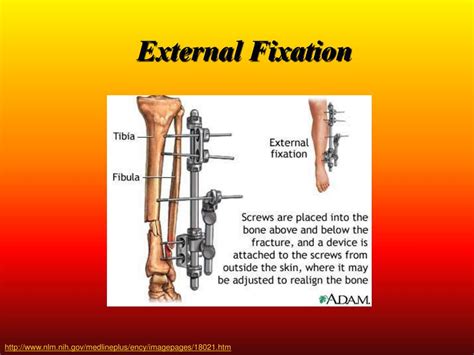 PPT - Fracture Fixation Internal & External PowerPoint Presentation ...