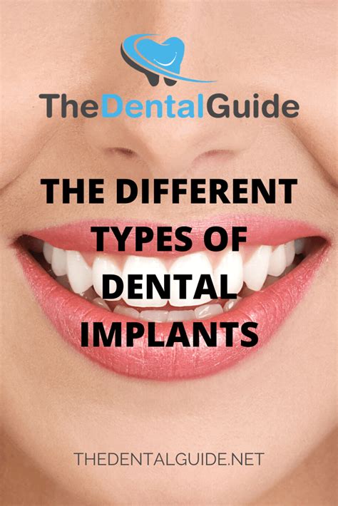 The Different Types of Dental Implants - The Dental Guide USA