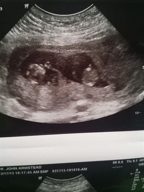 11 Weeks Pregnant Ultrasound Twins