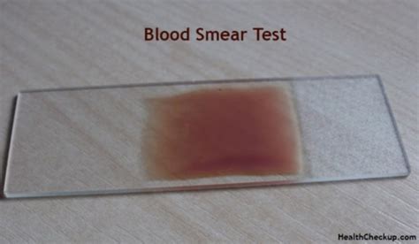 Peripheral Blood Smear Test Purpose, Procedure, Results & Interpretation