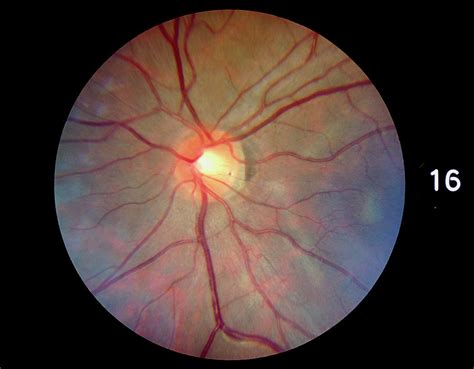 Fundus Camera Image Of A Normal Retina Photograph by Rory Mcclenaghan ...