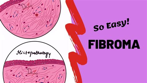 Fibroma | ORAL PATHOLOGY - YouTube