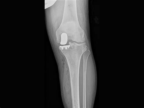 Partial Knee Replacement Procedure